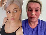 Woman reveals how steroid creams prescribed for her eczema left her skin ‘oozing, burnt and cracked’